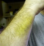 arm_bruise.jpg