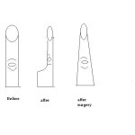treys finger.jpg