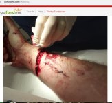 webb gofundme wrist.jpg